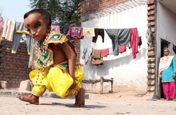 印度先天畸形儿童被认为是神灵转世，每天都有村民前来朝拜！