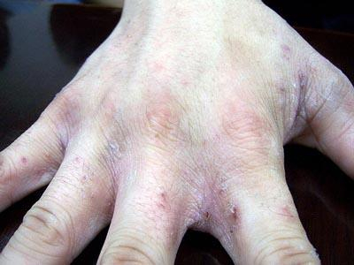 疥疮的病因病理是什么