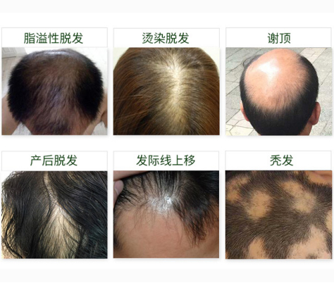 新生植发行业动态：技术革新与顾客信任并进