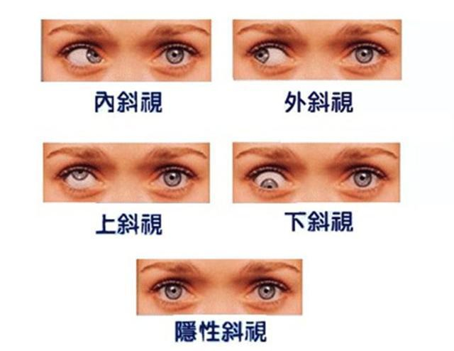 斜视的原理？教你如何识别斜视并通过训练改善？|斜视|内斜视|外斜视|双眼|外肌_新浪新闻