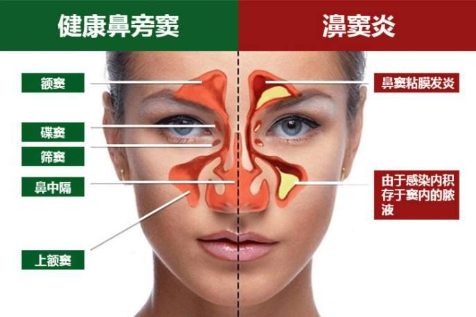 鼻窦炎大解析，从症状到根源，难怪总是治不好？|鼻息肉|鼻窦炎|鼻腔_新浪新闻
