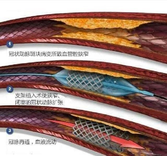 心血管医生告诉您：放完支架要记住的十件事
