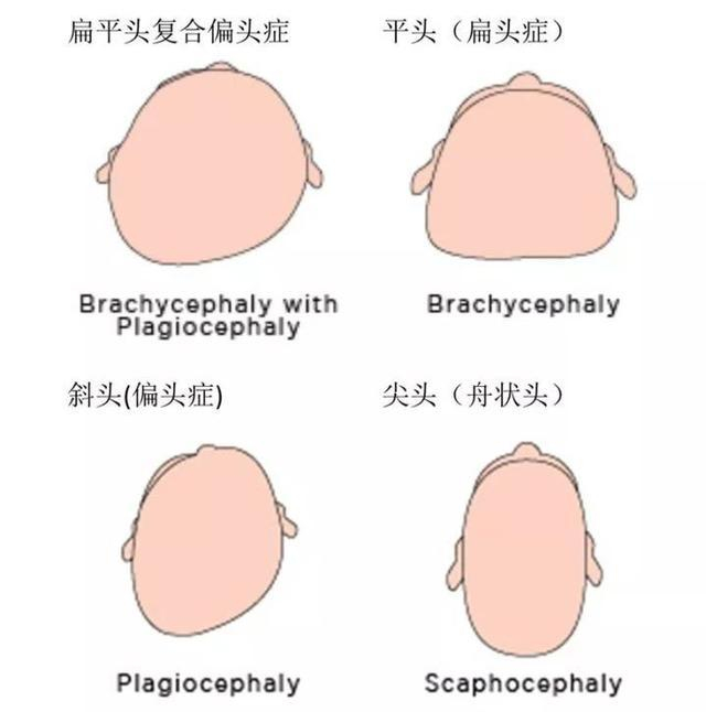 扁头偏头综合症,到底怎么办?