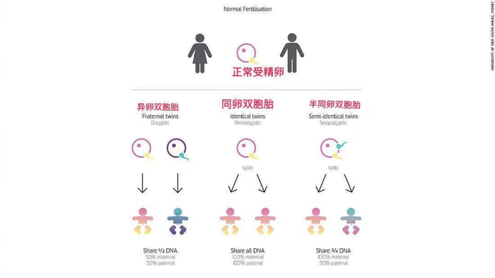 世界上第二个半卵双胞胎在澳洲被发现!这是怎么形成的呢?