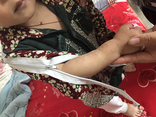 　　为方便给桐桐做康复操，他的所有的衣服都经过了特殊“改造”，右臂上手术后的疤痕清晰可见。澎湃新闻记者 陈雷柱 图