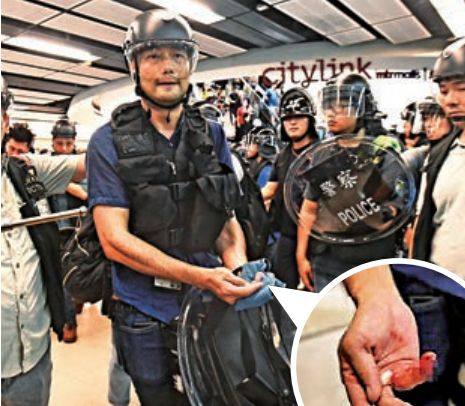 被咬断手指的警员已接上断指，但不确定未来恢复情况。 图源：大公文汇网