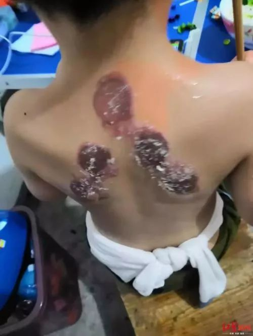  发生不良反应4天后的情况（图片来源：红星新闻）