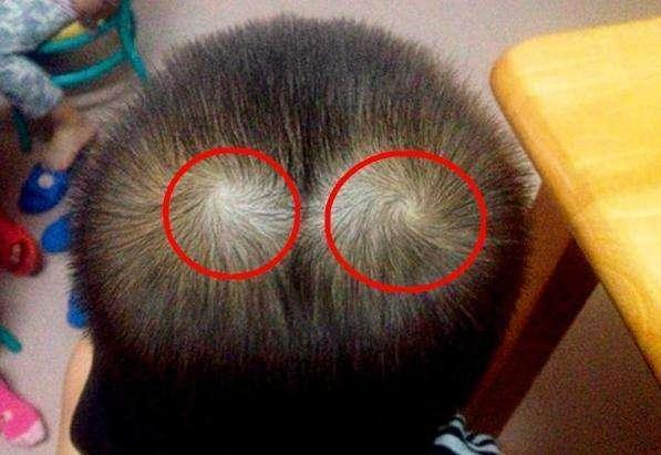 宝宝头上一个旋、两个旋、三个旋,这真能影响孩子的性格吗?