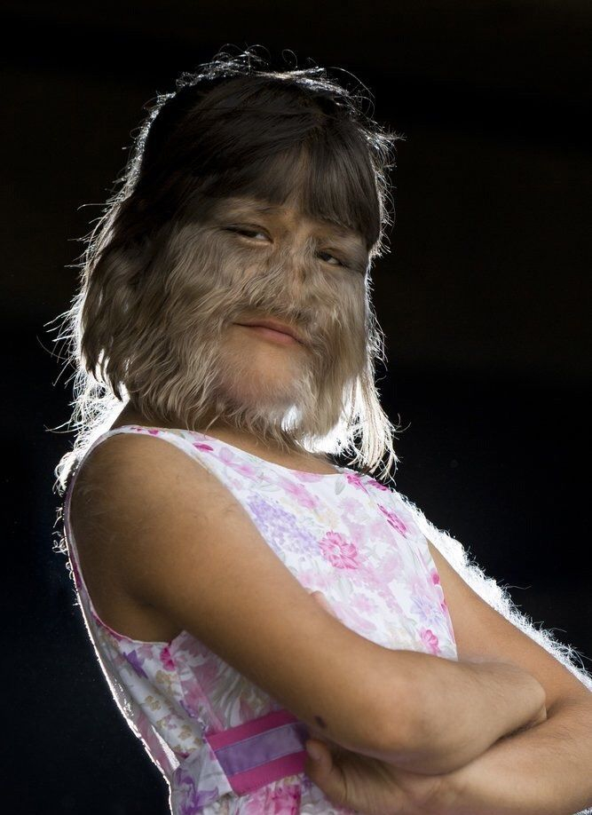 除了面部毛发比普通人棕黑茂盛之外,小女孩的身体各项体能正常,并因"