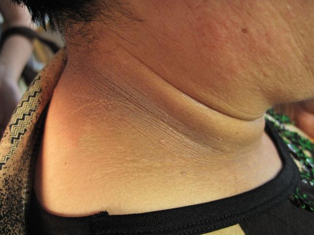 不吸烟的人也会得肺癌皮肤有3种异常表现抓紧查肺ct