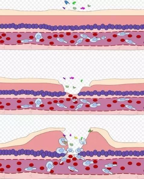 炎症风暴：人体免疫系统，是怎样反噬自身的？