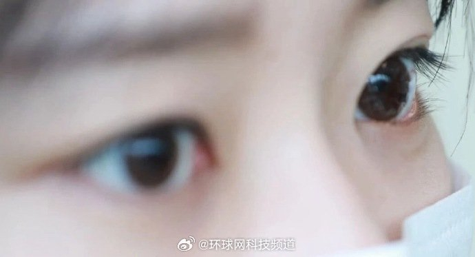 近视600度成眼球风险临界值，专家建议高度近视者每年查眼底