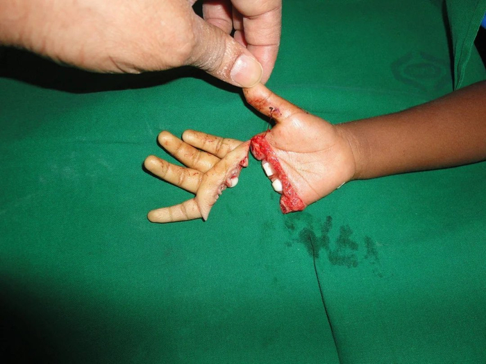 4岁患儿成功接受关键手术重获新生