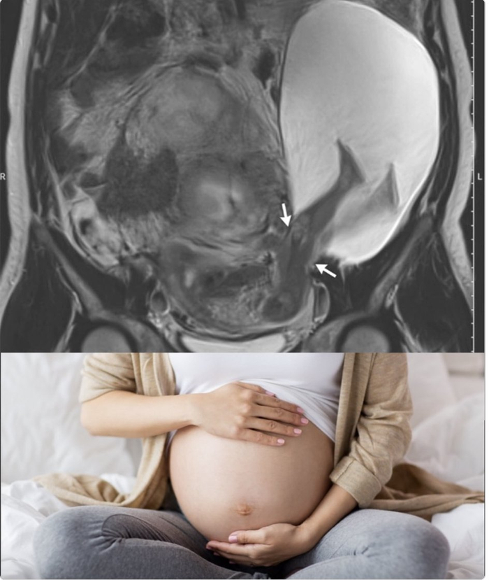 33岁六胎妈妈孕22周子宫撕裂2.5厘米，30周剖腹产母子平安