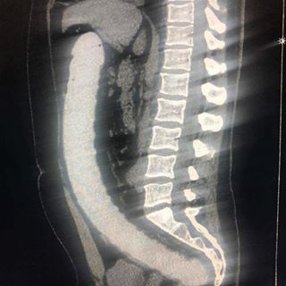 急诊数据显示男性直肠异物是女性40倍