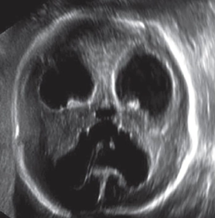 新生儿脑积水现米老鼠外观,颅超声显示脑室扩张