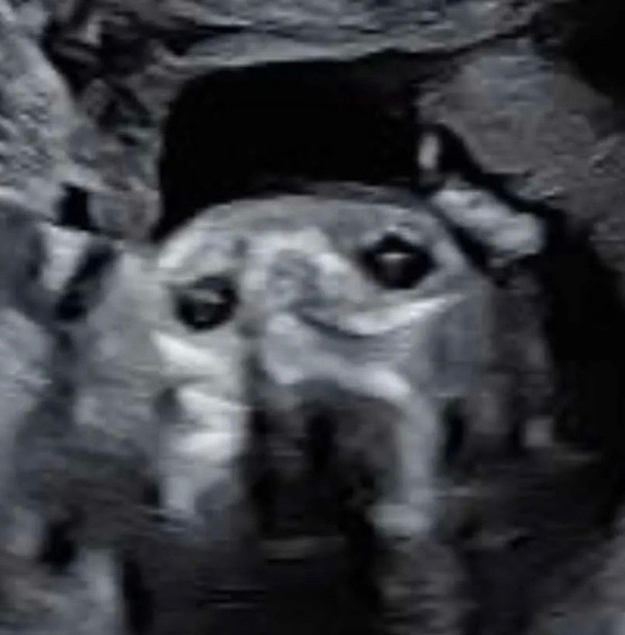 胎儿超声现狗脸图案，医生解释为伪影现象