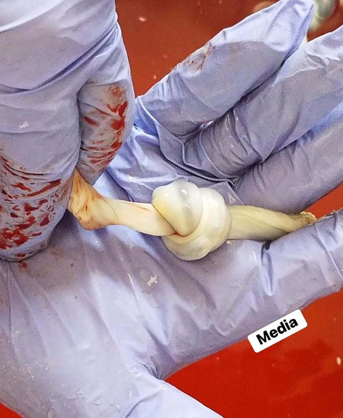 胎儿脐带真结可致缺氧缺血性脑病，超声确诊后多建议剖宫产