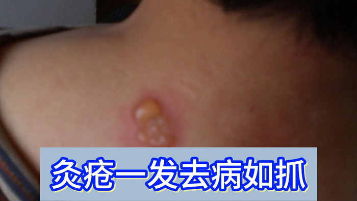 灸疮一发去病如抓