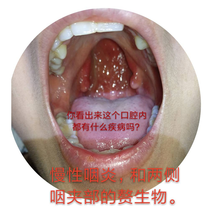 咽炎后咽壁狭窄中医火针调理