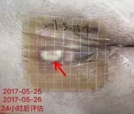 压疮伤口换药操作|敷料|伤口|胶体