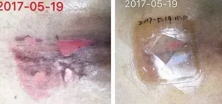 医用伤口护理膜怎么用压疮伤口换药操作_新闻资讯_第4张_活检穿刺产品网 医用伤口护理膜怎么用压疮伤口换药操作_https://www.jmylbn.com_新闻资讯_第4张