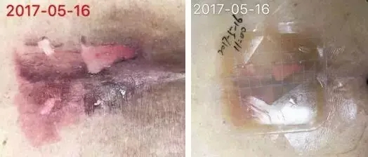 医用伤口护理膜怎么用压疮伤口换药操作_新闻资讯_第2张_活检穿刺产品网 医用伤口护理膜怎么用压疮伤口换药操作_https://www.jmylbn.com_新闻资讯_第2张