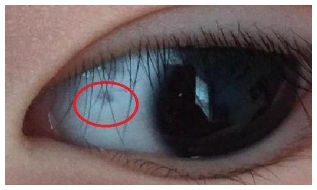 为啥宝宝眼中有个“小黑点”？多半是3种原因所致，你家娃有吗？
