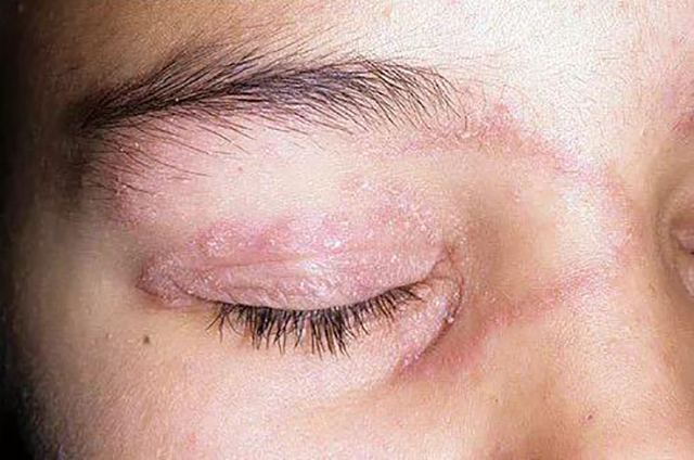 为什么我的脚气会长在脸上?