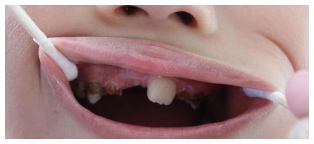 3岁儿童一半被龋齿困扰，父母做好这5点，孩子才能拥有健康好牙