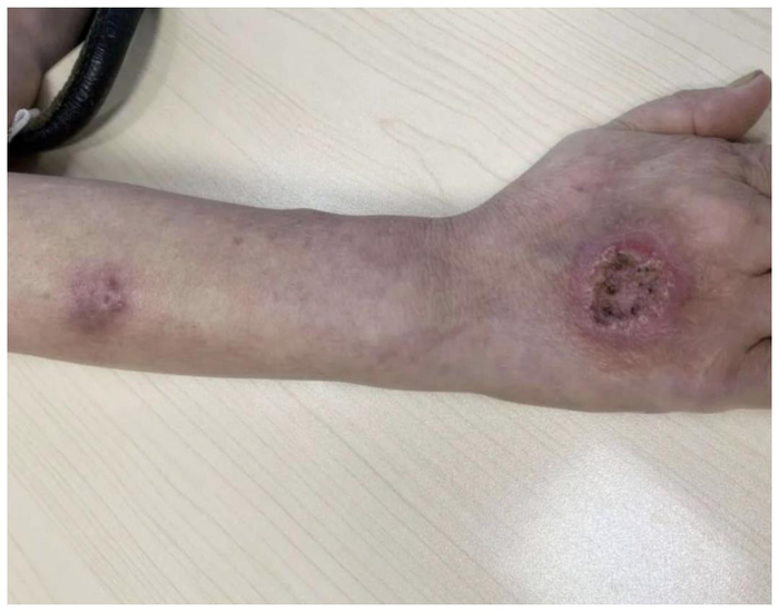 女子手背惊现大窟窿差点截肢做家务的宝妈们都要小心了