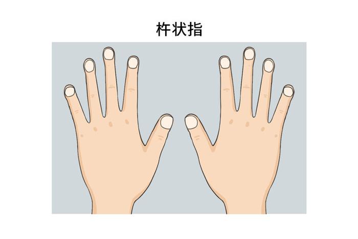 提醒:手指出现4个症状,可能是疾病的信号