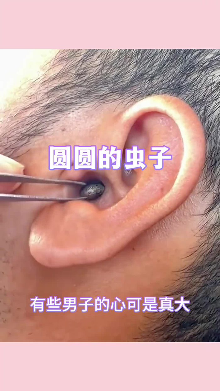 圆圆的虫子,居然钻进耳朵里