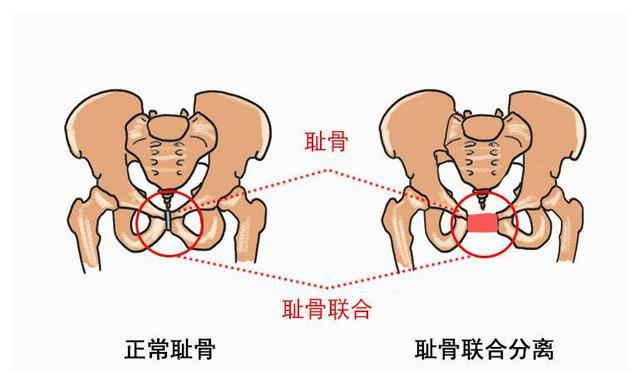 “耻骨痛”到底是哪里痛?孕期有四类孕妇容易被它“缠身”