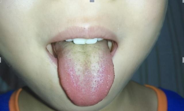 一张图，教你学会看孩子舌苔