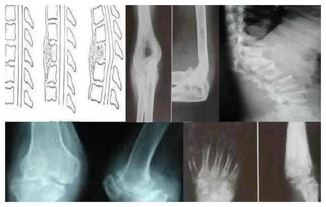 夹板肺是什么你对「骨关节结核病」认识有多少-上海聚慕医疗器械有限公司