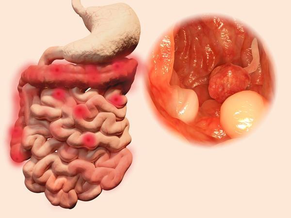 大腸癌早期生存率高但常被患者以為是痔瘡一文教你區別它們