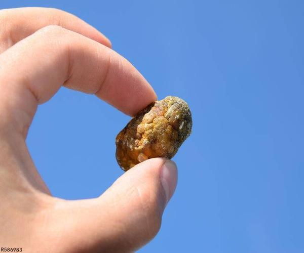 医生:若是这些部位的胆结石需尽快处理!