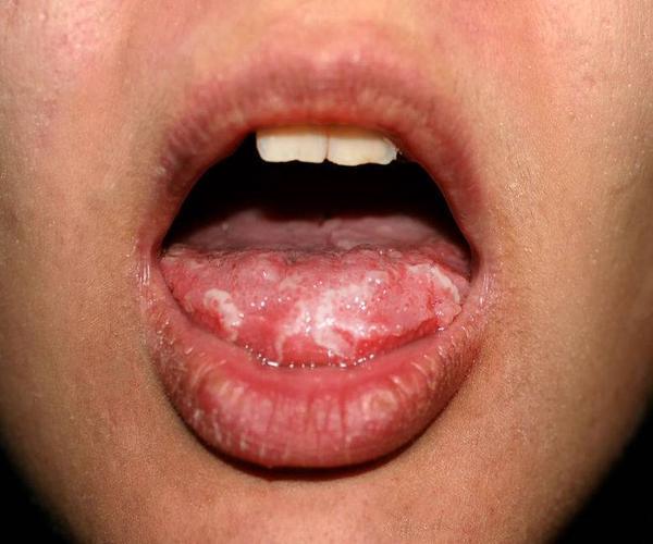 舌头长溃疡是怎么回事?医生:若同时伴随这些症状,需及时就医!