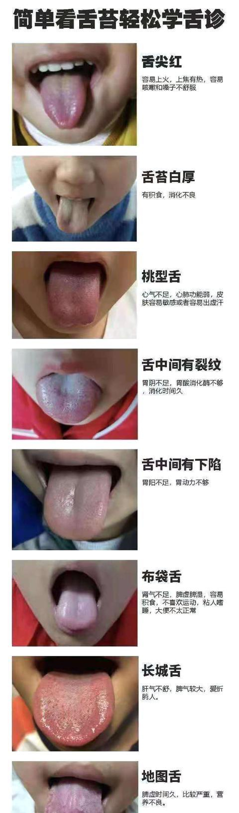 一张图,教你学会看孩子舌苔