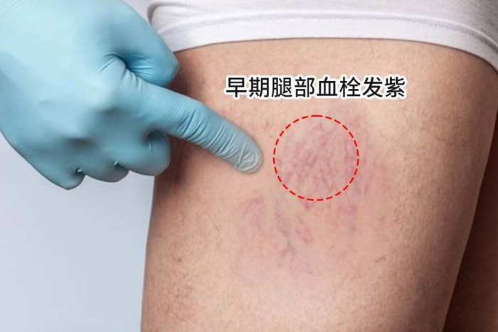 血栓来临手脚先知提醒手脚出现4种表现或提示你血管堵了