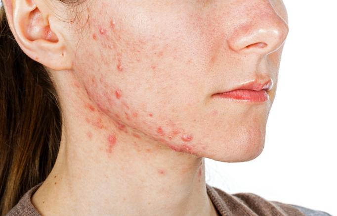 粉刺,痘痘,青春痘等都是痤疮的俗称,是一种发生在毛囊皮脂腺单位的