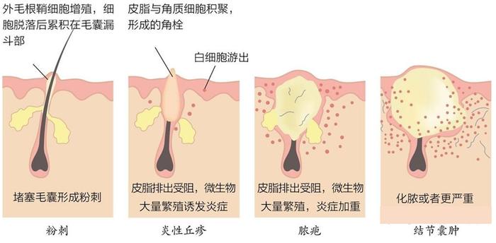 2,炎症性丘疹(中度Ⅱ級):通常來說都