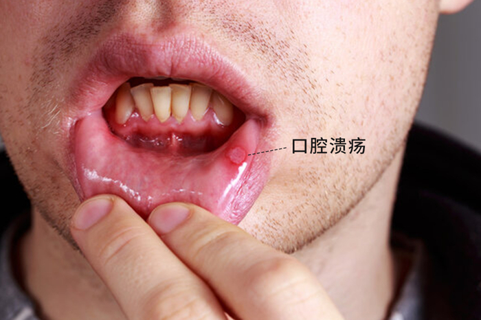 提醒:口腔出现这4种迹象,可能是癌症在靠近__财经头条