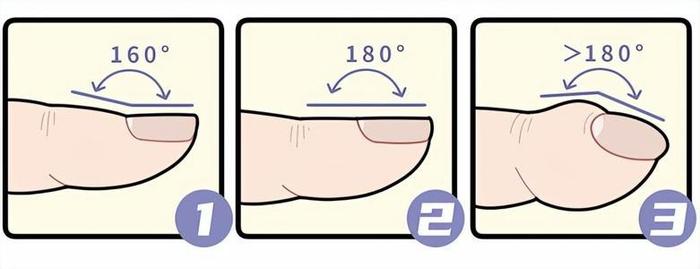 杵状指的鉴别方法图片