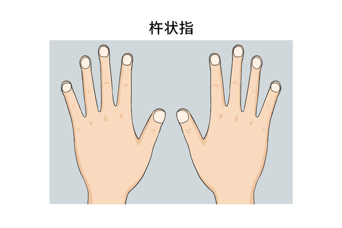 2,指甲上出现黑线指甲上出现黑线可能与指甲损伤,黑色素沉积相关,但也