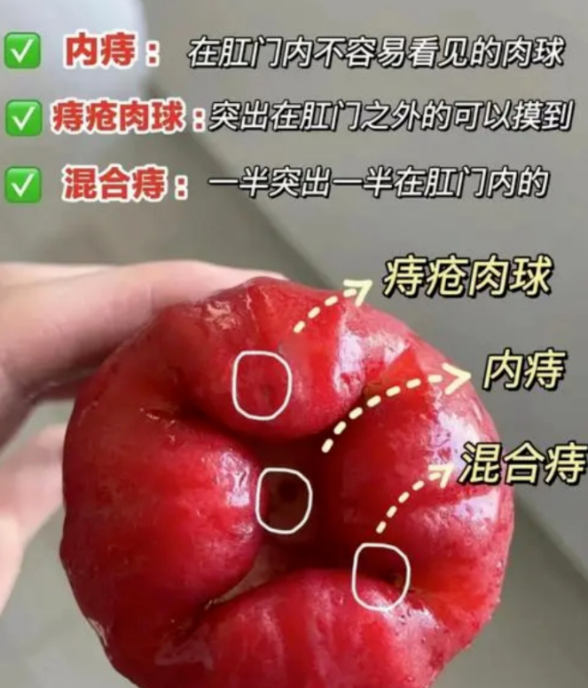 痔疮外痔肉球怎么消除?揭秘消除方法,重拾健康与自信!