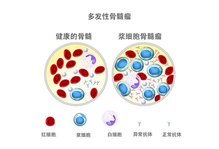 carvykti新适应症:作为复发/难治性多发性骨髓瘤的二线疗法|多发性