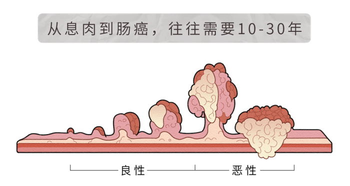 再三提醒:4种东西尽量少吃,再馋也要管住嘴|肠息肉|肠癌|息肉_新浪
