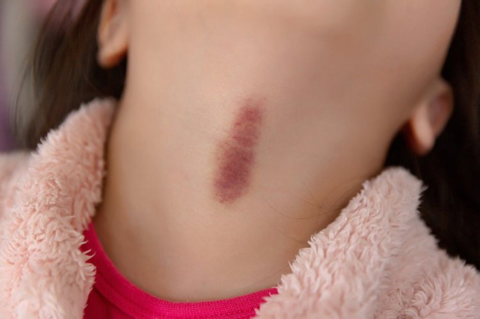 观察到死者脖子侧边有很深的吻痕,加上女子死前没有任何病史和外伤